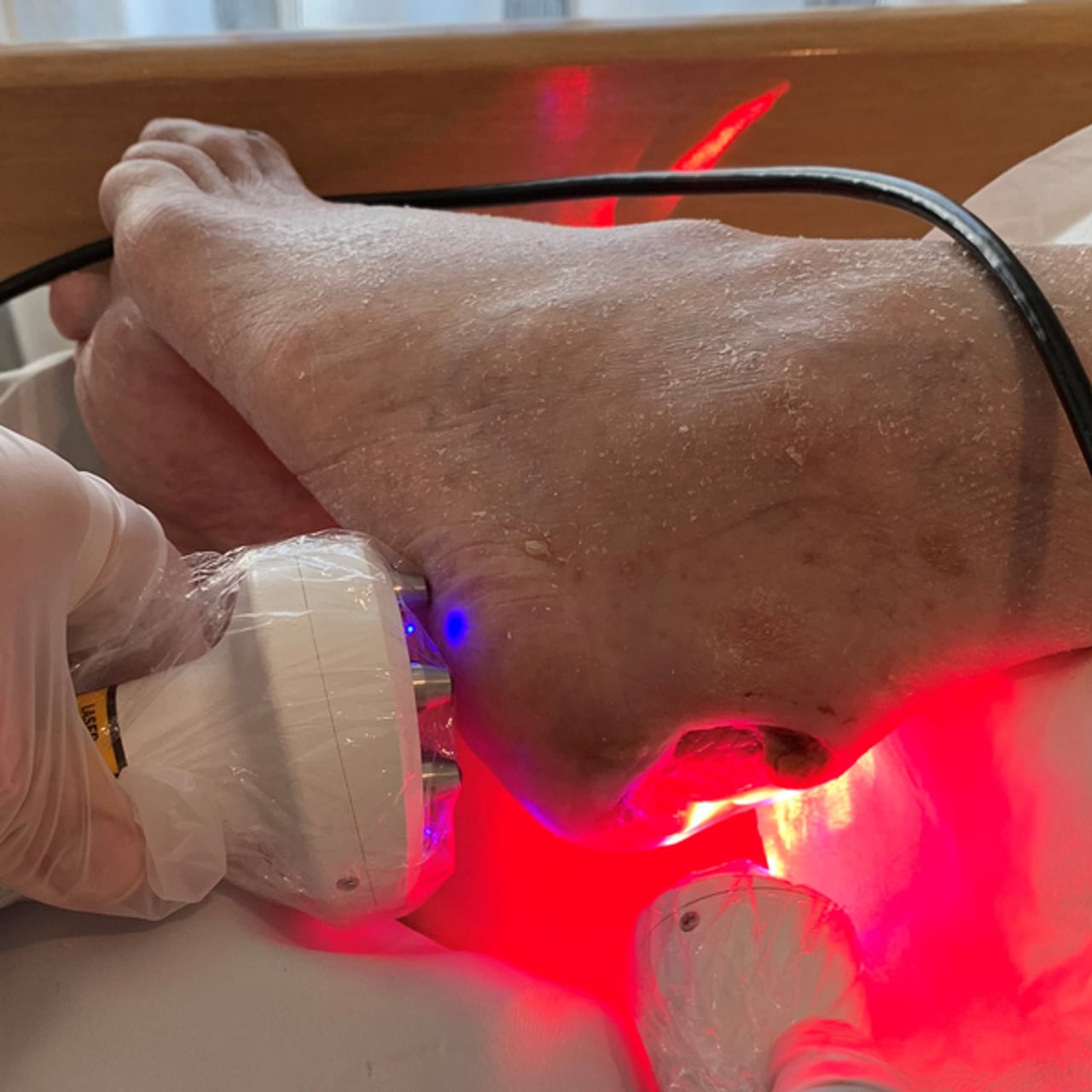 Laserbehandling av sv&aring;rl&auml;kt s&aring;r.
