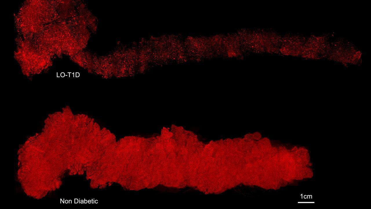 Three dimensional images of entire human pancreases in which the islets of Langerhans are stained for insulin (red). Despite the marked difference between the pancreas from the non diabetic and the type 1 diabetic donor, the latter still contained hundreds of thousands of insulin producing cells.