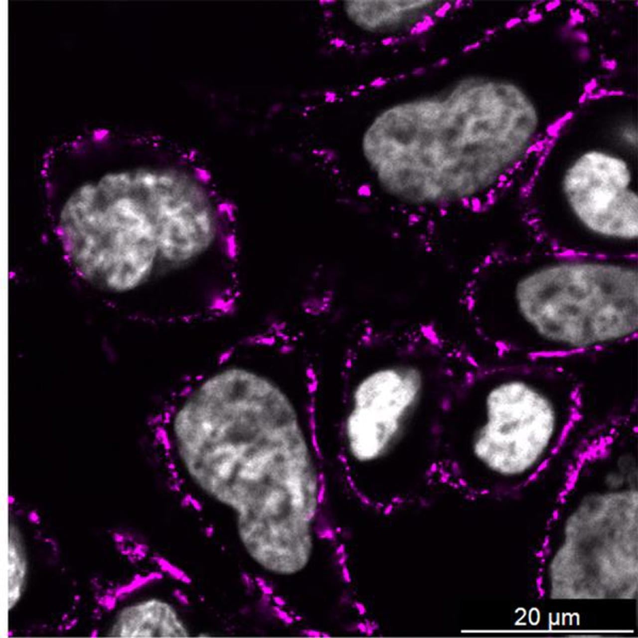 Bilden visar hur NheA-O (markerad i magenta) binder till cellmembranet hos kolorektala cancerceller.