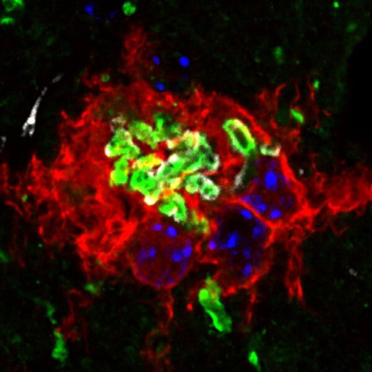 Bilden visar klumpar av SOD1-protein (grönt) som bildas i ryggmärgen vid en typ av ALS. Antikroppar som bundit till SOD1-klumparna i de behandlade mössen ser man som små vita fläckar runt det gröna. I rött syns hjärnans immunceller som omringat det felaktiga proteinet för att försöka bryta ned det.