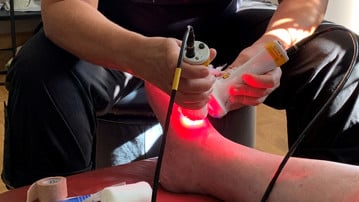 Laserbehandling av sår på foten.