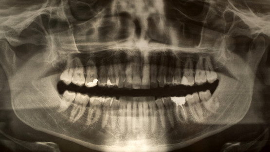 Panoramic dental x-ray of a young adult male. Genrebild från Mostphotos.