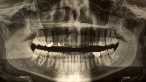 Panoramic dental x-ray of a young adult male. Genrebild från Mostphotos.