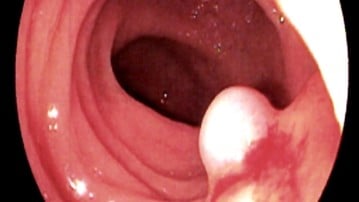 En polyp inne i tarmen kan vara början till cancer som upptäcks vid koloskopi.