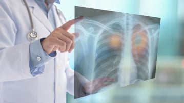 lung x-ray radiography concept. radiology doctor examining at chest x ray  of patient at hospital room.
