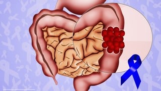Kolorektalcancer, schematisk illustration av cancer i tjocktarmen